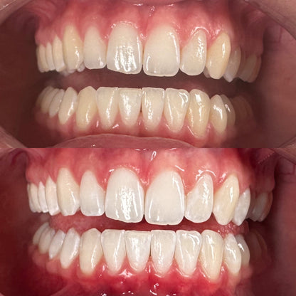 DAY 8 — Holiday Deal $50 OFF Professional Teeth Whitening