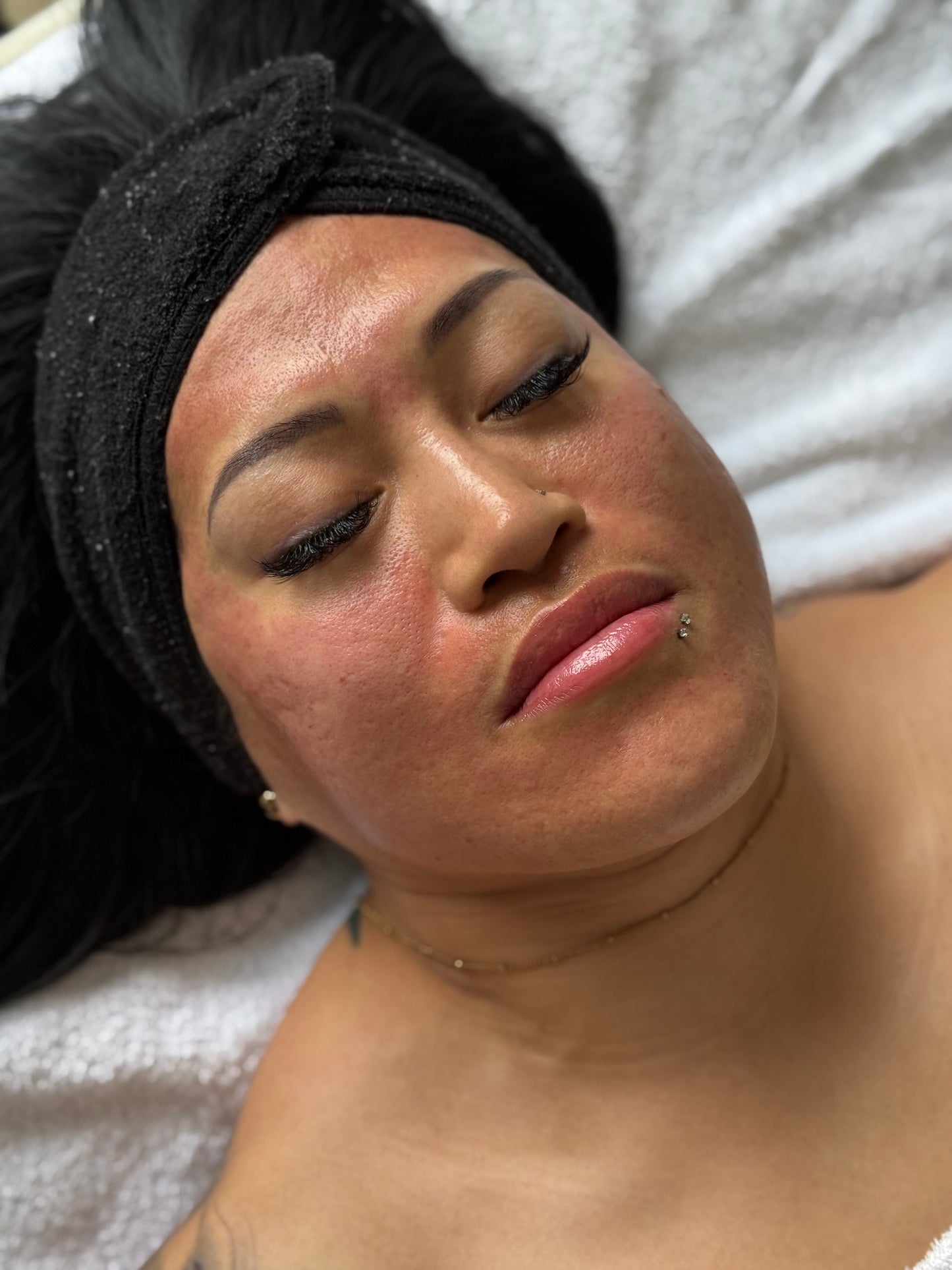 DAY 5 — Holiday Deal 20% OFF Microneedling