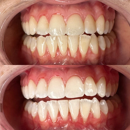 DAY 8 — Holiday Deal $50 OFF Professional Teeth Whitening