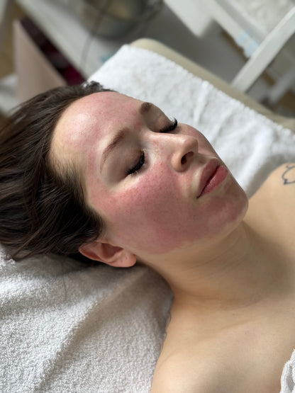 DAY 5 — Holiday Deal 20% OFF Microneedling