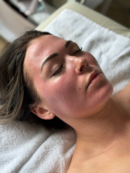 Microneedling Day — Birthday Deal #5