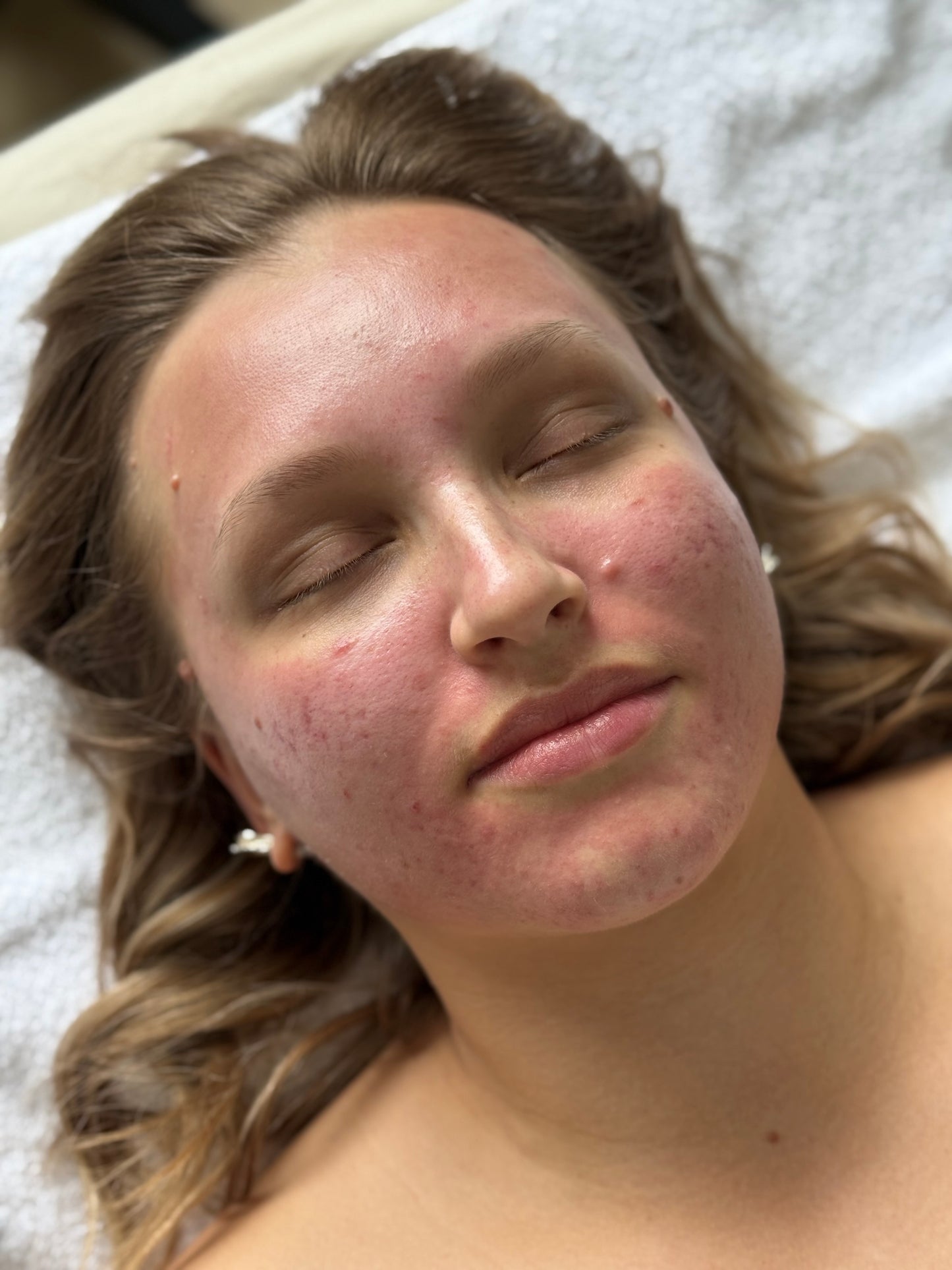 DAY 5 — Holiday Deal 20% OFF Microneedling