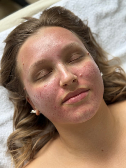 DAY 5 — Holiday Deal 20% OFF Microneedling