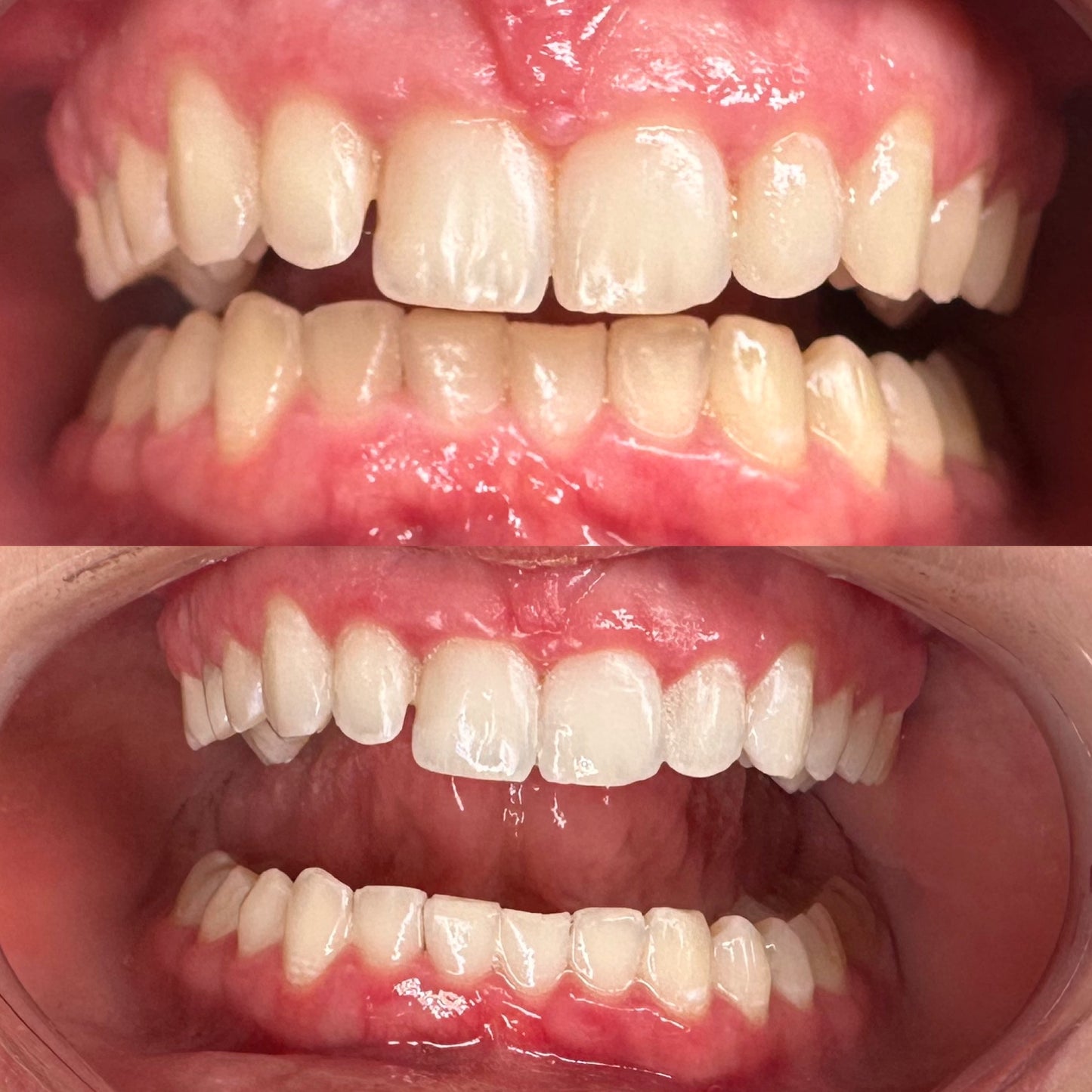 DAY 8 — Holiday Deal $50 OFF Professional Teeth Whitening