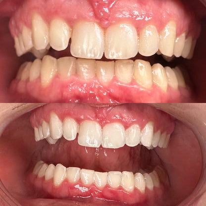 DAY 8 — Holiday Deal $50 OFF Professional Teeth Whitening