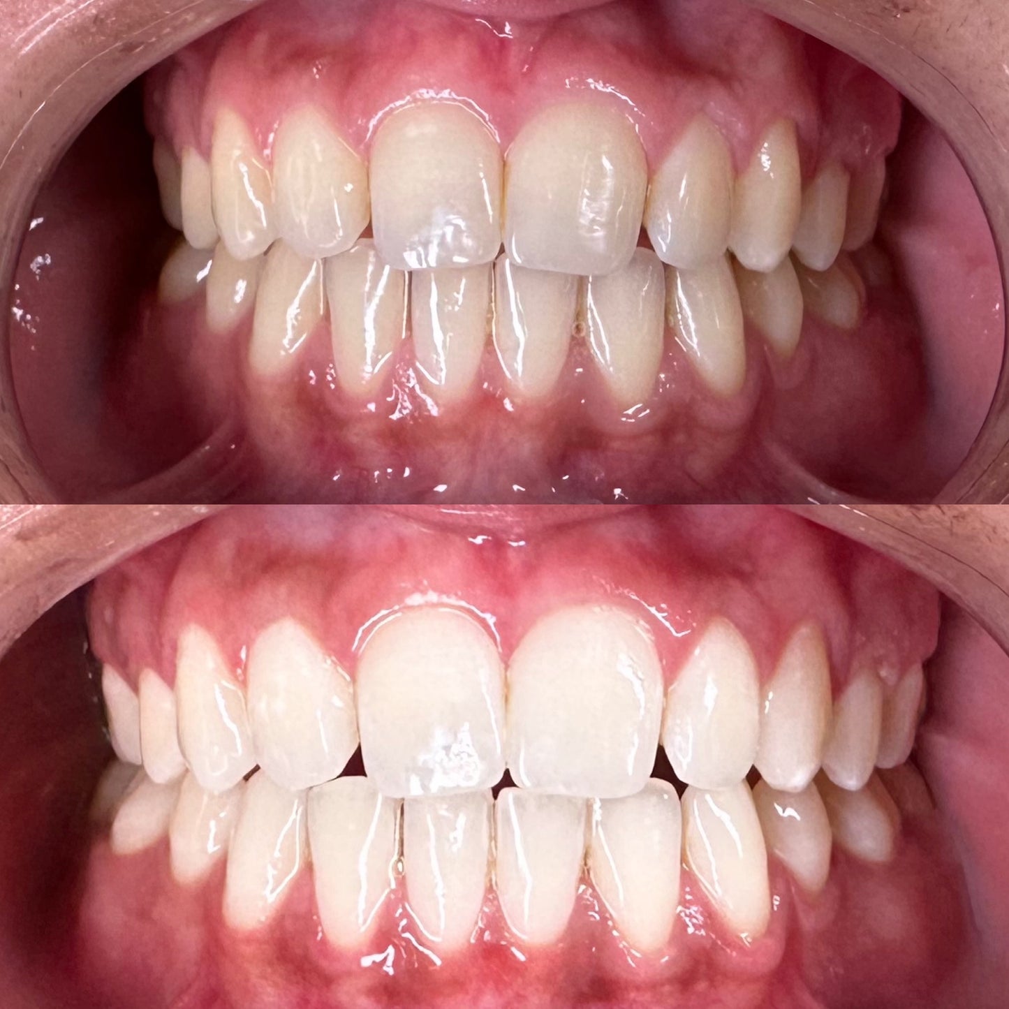 DAY 8 — Holiday Deal $50 OFF Professional Teeth Whitening