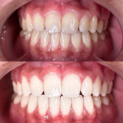 DAY 8 — Holiday Deal $50 OFF Professional Teeth Whitening