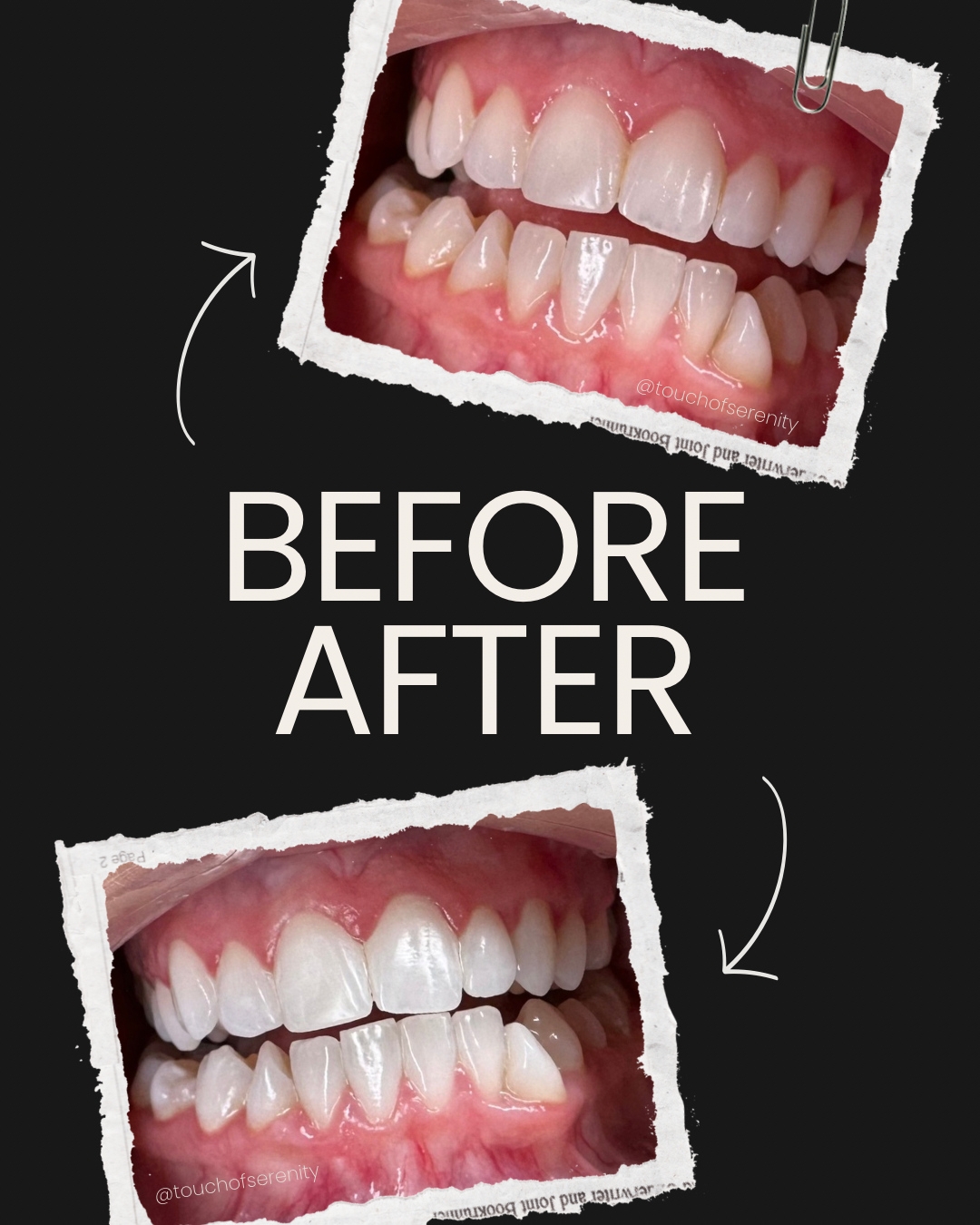 DAY 8 — Holiday Deal $50 OFF Professional Teeth Whitening